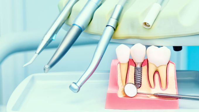 implantologia-dentale