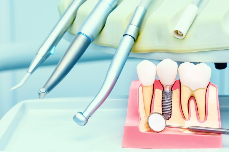 implantologia dentale