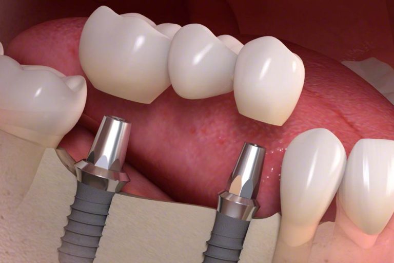 protesi ponte su impianti