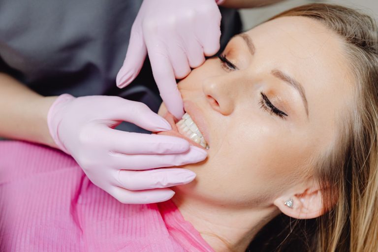 sbiancamento dentale
