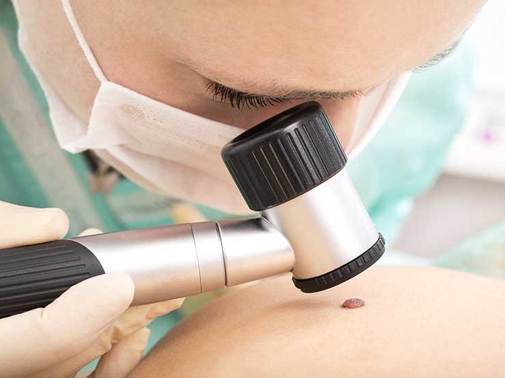 visita melanoma