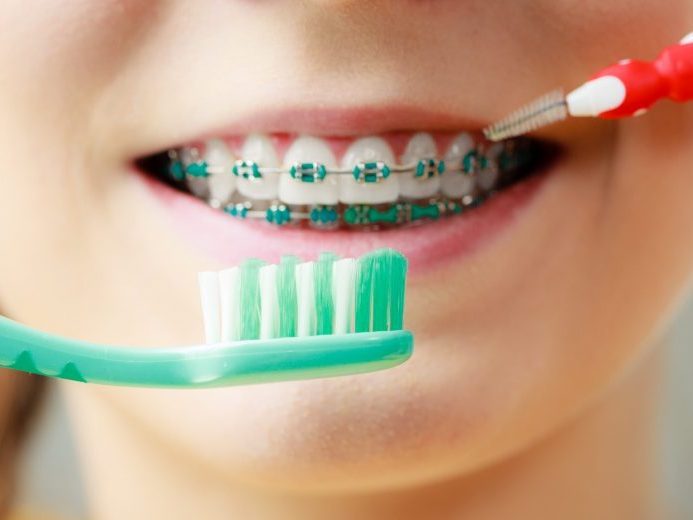 come pulire apparecchio