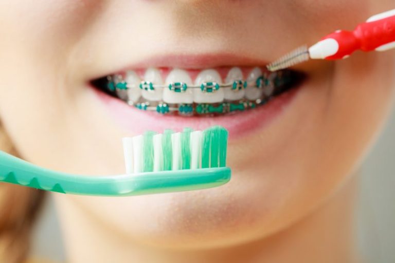 come pulire apparecchio