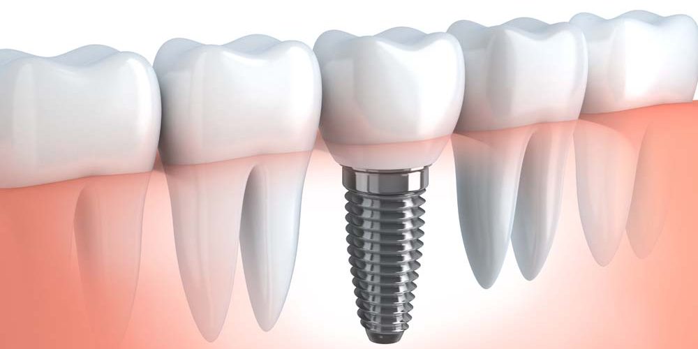 impianti-dentali