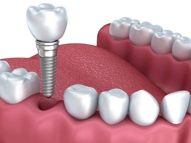 pulizia protesi fissa