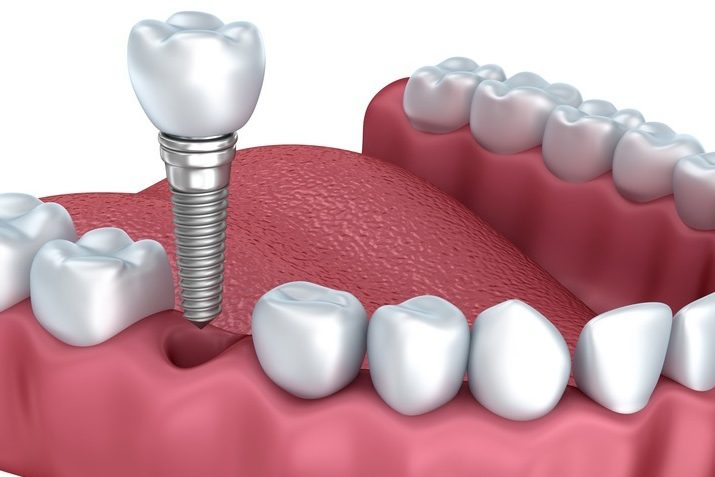 pulizia protesi fissa