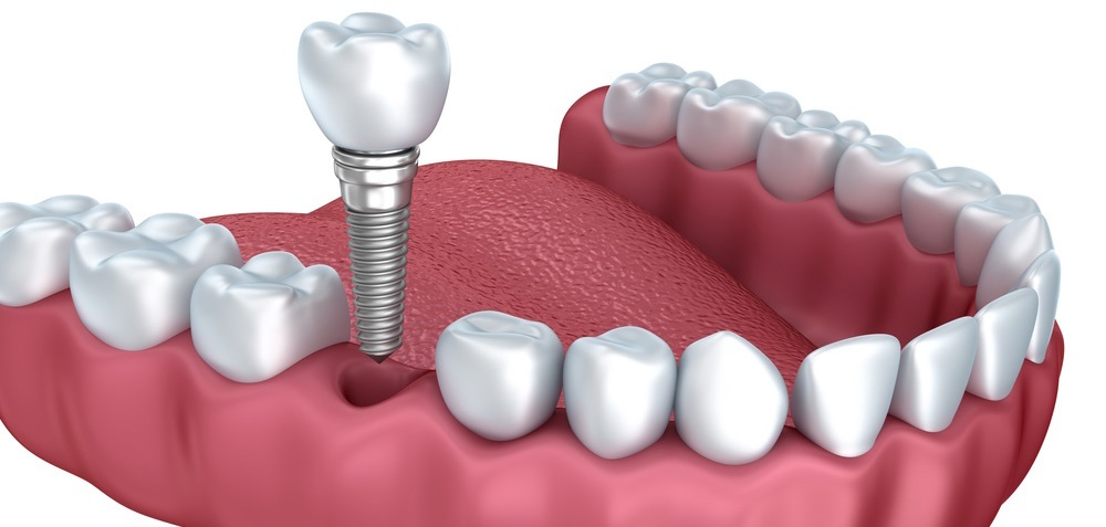 pulizia-protesi-fissa