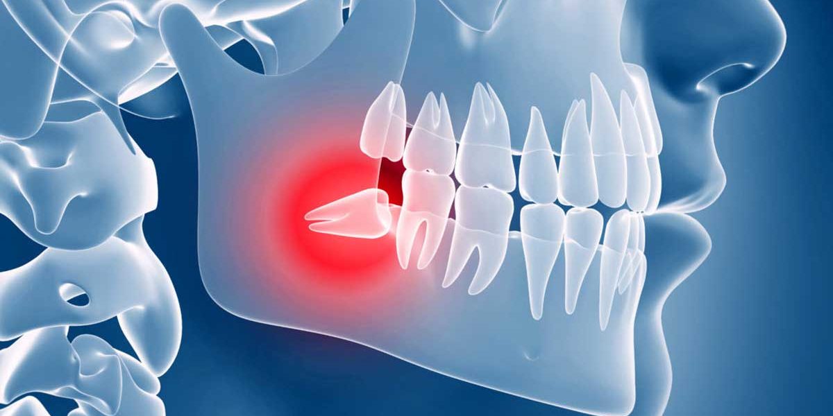 Denti del giudizio domande e risposte Centro Medico San Luca