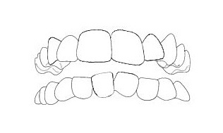 affollamento dentale