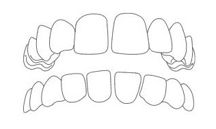 spazi denti