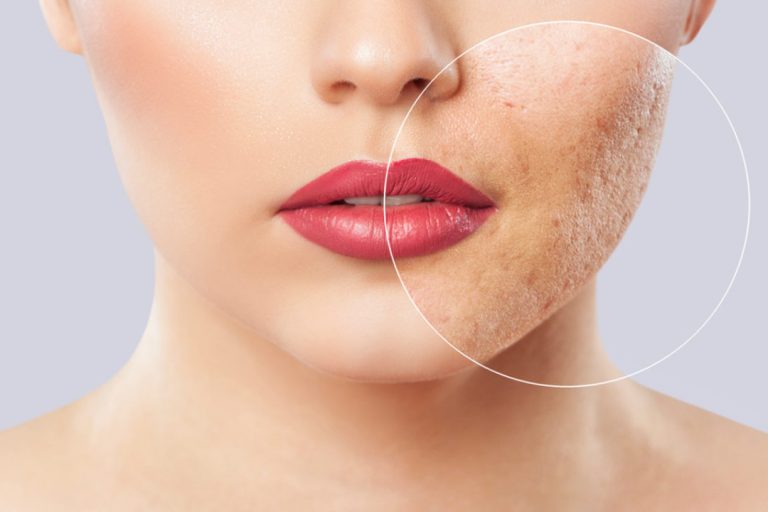 cura acne cause rimedi