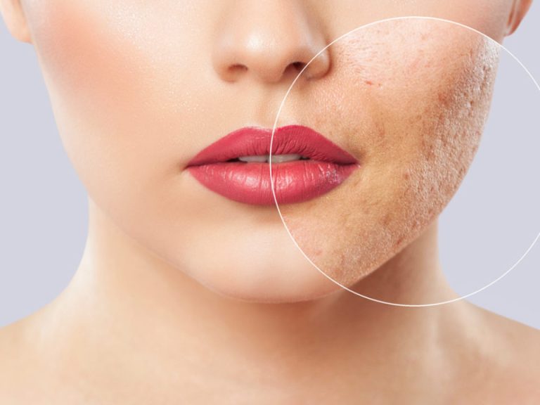 cura acne cause rimedi