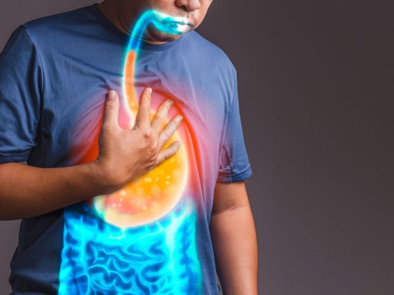 reflusso gastroesofageo