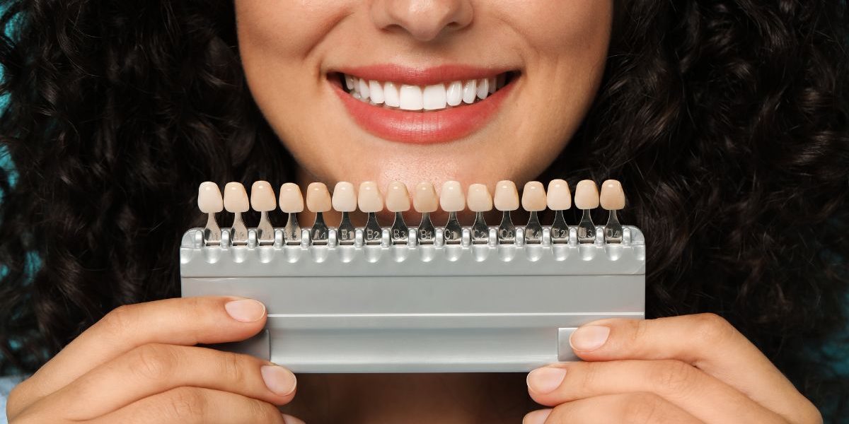 faccette dentali