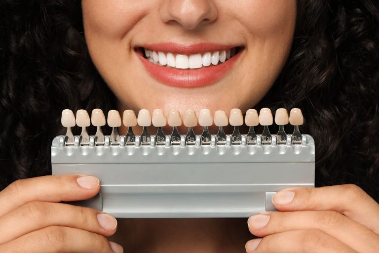 faccette dentali