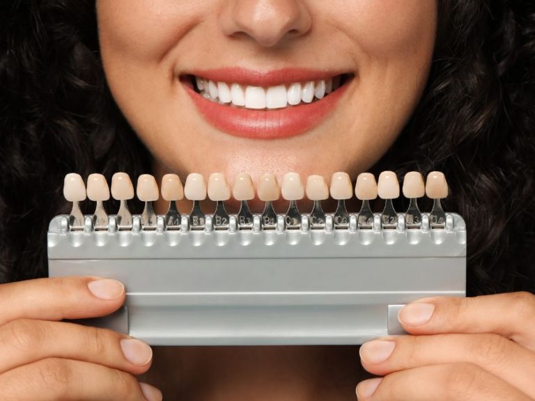 faccette dentali