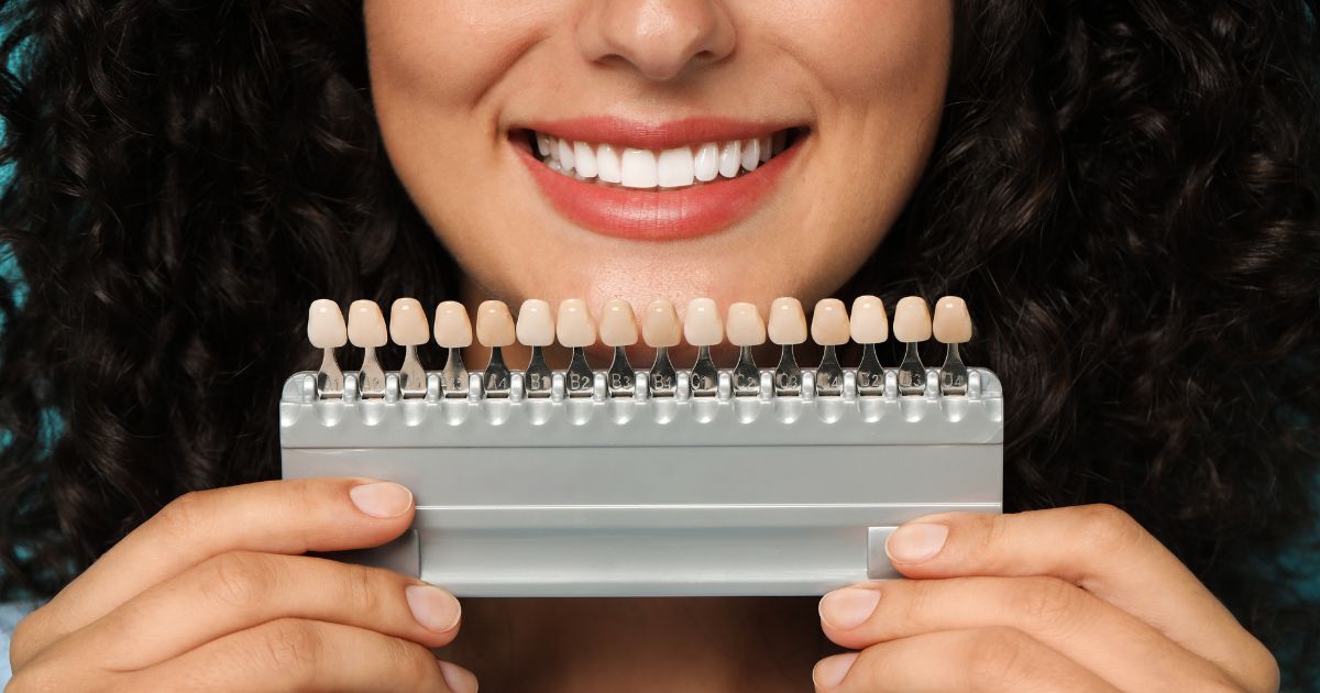 faccette dentali